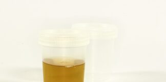 Jaki jest mocz przy chorej trzustce? Jaki jest mocz przy chorej trzustce?