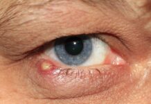 Czy zapalenie płuc słychać przez stetoskop?